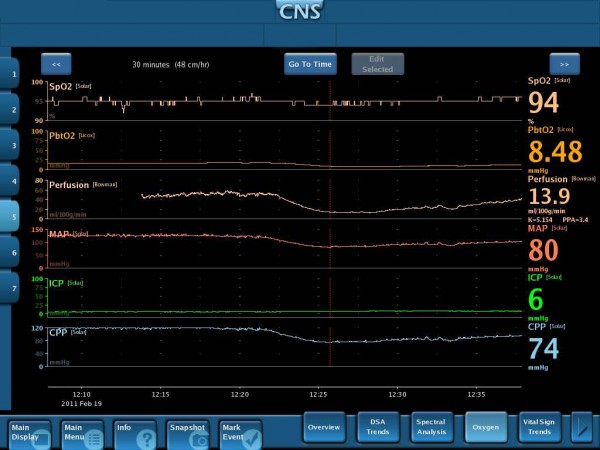 Multimodal monitoring display showing simultaneous cerebral parameters